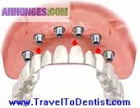 Implants dentaires seulement à 375 euro (le prix comprend le pilier)