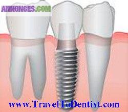 Implants dentaires seulement à 375 euro (le prix comprend le pilier)